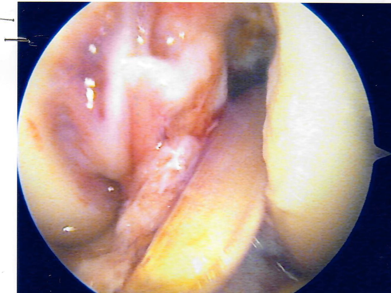 magnani-LCA-ARTROSCOPIA